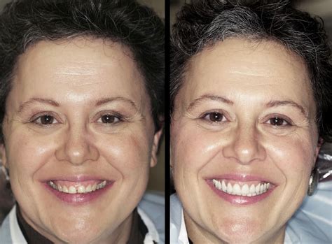 large gums small teeth